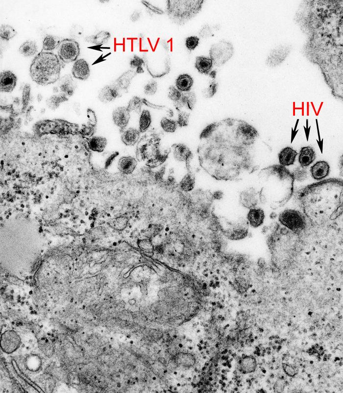 Imagem de microscópio mostra, em preto e branco, diversos agrupamentos de células, algumas com tons mais claros e formatos regulares, outras em tons mais escuros e irregulares. Dois desses segmentos são identificados: o primeiro, à esquerda, mostra o vírus HTLV-1, mais claro e regular; o segundo, à direita, mostra o HIV, mais escuro e irregular. 
